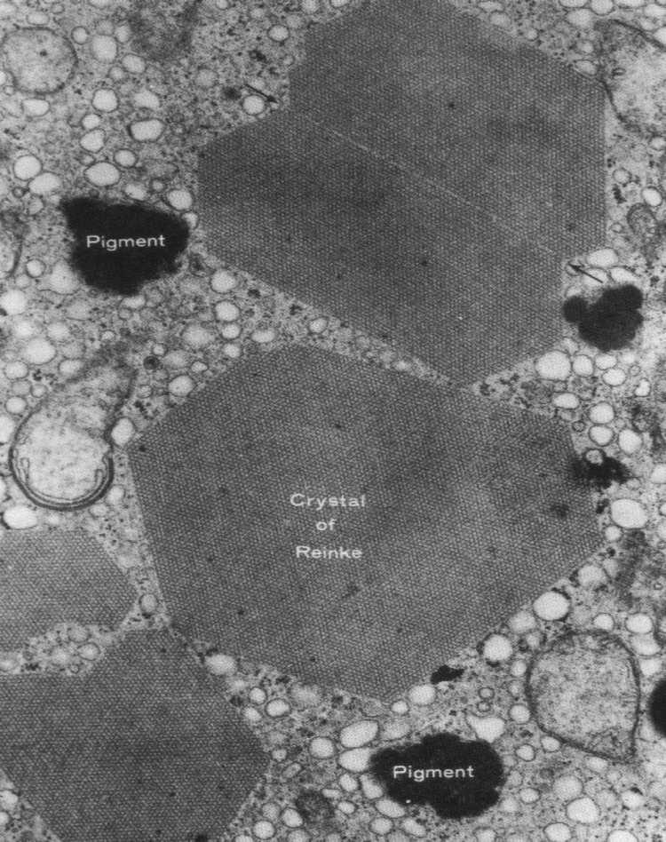 osłonkowo-luteinowe komórki śródmiąższowe (komórki osłonki wewnętrznej pozostałe po atrezji