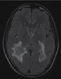 Inne choroby demielinizacyjne Choroby SM-podobne Zapalenie nerwu wzrokowego (neuritis optica) w przebiegu SM lub izolowane Choroba Devica (neuromyelitis optica) zapalenie nerwu wzrokowego + zapalenie