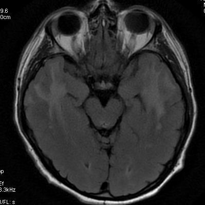 CADASIL mężczyzna 37 lat CADASIL (cerebral autosomal dominant arteriopathy
