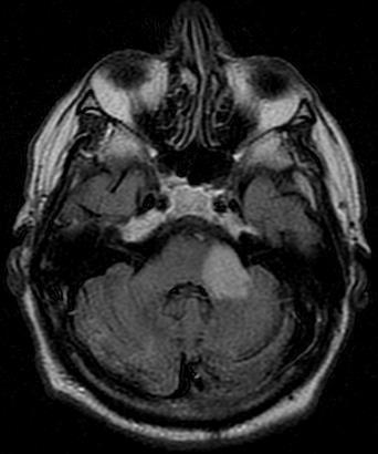 Rhombencephalitis (brainstem encephalitis)