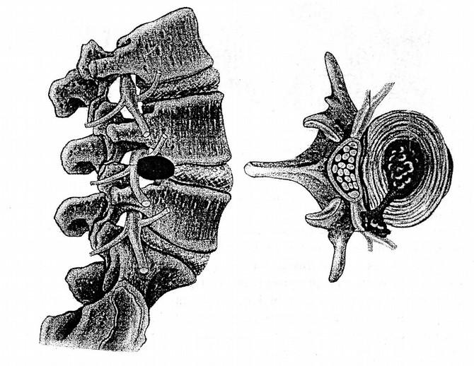 Przepuklina (wypadnięcie)