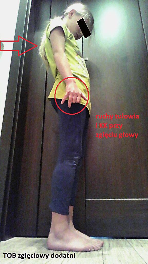 Piel Zdr Publ. 17;26(1):5 11 9 Ryc. 7. Dodatni test TOB ZG Fig. 7. Positive TLR FLX test z grupy j przy pełnej integracji tego odruchu u 95 dzieci z grupy j.