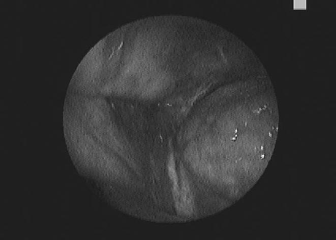 Były to podwaliny do powstania nowatorskiej myśli diagnostycznej. Jednak dopiero dzięki sformułowaniu podstaw działania lasera w 1917 r. przez Alberta Einsteina i jego skonstruowaniu w 1960 r.