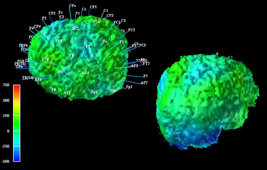 EEG + MRI