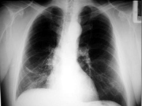 Pneumonologia i lergologia Polska 2010, tom 78, nr 5, strony 369 373 Rycina 1. Radiogram klatki piersiowej. Poszerzenie cienia prawej wnęki z cechami zaburzeń upowietrznienia miąższu Figure 1.