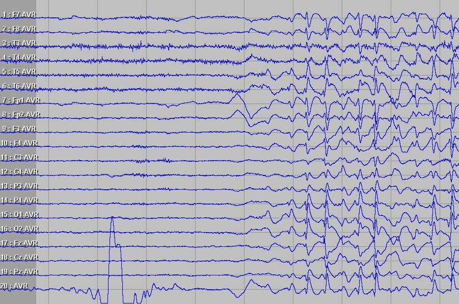 EEG 2