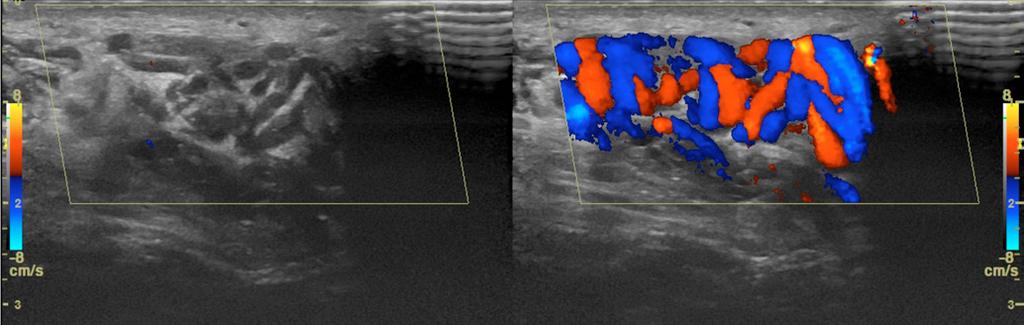The value of ultrasonography in the diagnosis of varicocele A B Fig. 2. A. Varicocele. B. Regurgitation during the Valsalva maneuver in color Doppler Ryc. 2. A. Żylaki powrózka nasiennego. B. Fala wsteczna podczas próby Valsalvy w prezentacji kolorowego dopplera movements are as limited as possible.