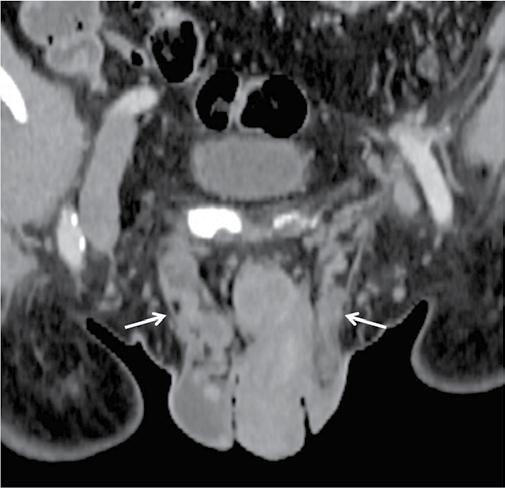 The value of ultrasonography in the diagnosis of varicocele A B Fig. 4. A. Computed tomography: a 70-year-old patient with varicocele, with larger varicocele on the right (arrows). B. A large right renal cell carcinoma (RCC) with lymph node metastases.