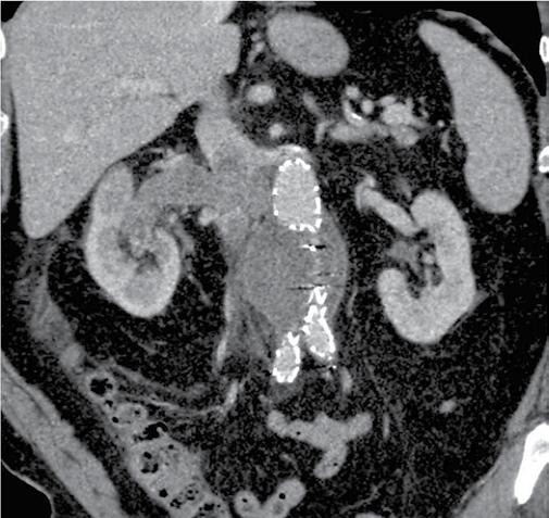 B. Widoczny jest duży guz prawej nerki (renal cell carcinoma, RCC) z przerzutami do węzłów chłonnych. C.