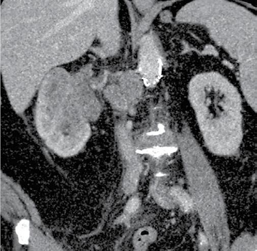 (ascending venography) or as an introduction to intravascular treatment (ascending or descending venography) to evaluate the anatomy of collateral circulation and developmental variations (9,10).