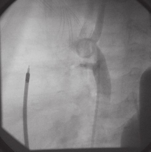 Folia Cardiologica Excerpta 2011, tom 6, nr 1 a czas stosowania fluoroskopii 1,6 min.