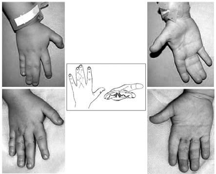Protocol of Treatment of Syndactyly 75 Fig. 5. Chart and clinical example of isolated simple syndactyly release Ryc. 5. Schemat i kliniczny przykład rozdzielania palcozrostu izolowanego prostego palców III/IV authors recommend simultaneous operations on both hands.