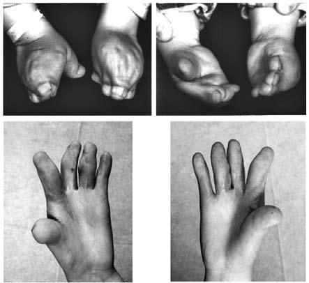 Isolated complete and incomplete foot syndactyly that does not impair the walking process is treated only for esthetic reasons, applying the same principles as in hand syndactyly.