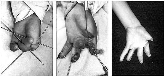 Widoczne skrócone niedorozwinięte palce z symfalangizmem Acrosyndactyly Constricted Rings Syndrome This syndrome has a varied morphology of bone and soft tissue deformities, the severity of which is