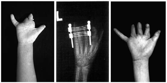 The most severe cases have transverse finger amputations with no proper phalanges and deficiencies in the metacarpal bones.