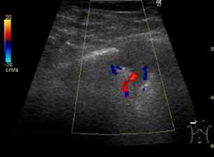 Rola przezklatkowej ultrasonografii płuc u dzieci / Role of lung ultrasound in paediatric patients The sum of alveolar-interstitial syndromes delivers information on the presence of pulmonary oedema
