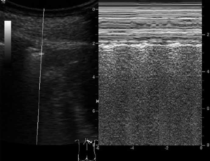 hyperechoic line korzystając z opcji M-mode. W opcji tej prawidłowy obraz określany jest jako obraz brzegu morskiego (seashore sign) (ryc.