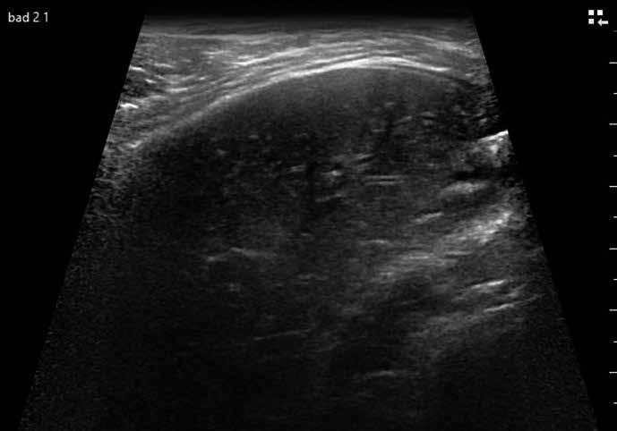 Rola przezklatkowej ultrasonografii płuc u dzieci / Role of lung ultrasound in paediatric patients oznaczenie Z, ostatnią z liter alfabetu, sugerując brak znaczenia klinicznego (18).