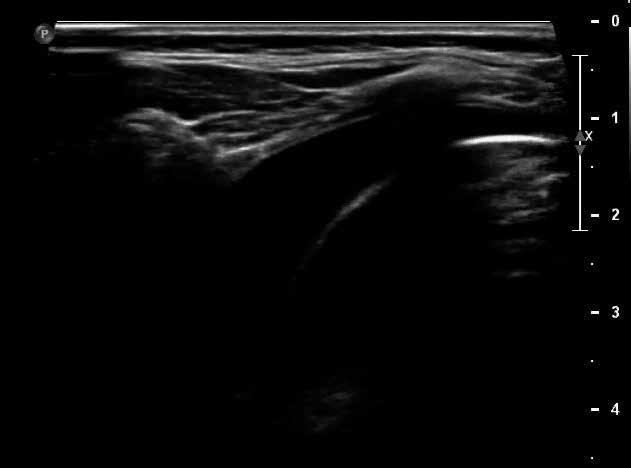 Rola przezklatkowej ultrasonografii płuc u dzieci / Role of lung ultrasound in paediatric patients Ryc. 5.