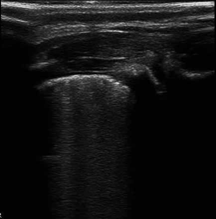 Magdalena Kryger, Wojciech Kosiak Ryc. 7. Zapalenie oskrzelików: dużo linii B, które mają tendencję do zlewania się Fig. 7. Bronchiolitis: multiple B-lines that tend to merge 394 komorą odmową a prawidłowo powietrznym płucem (35).
