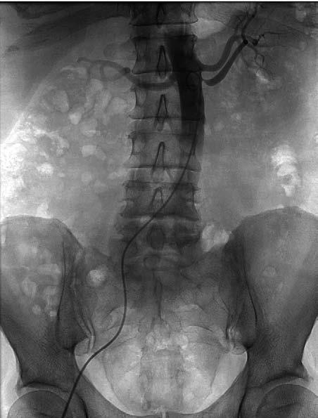 nadciśnienie tętnicze rok 2008, tom 12, nr 1 Rycina 1. Aortografia brzuszna zwężenie lewej dolnej tętnicy nerkowej Figure 1. Abdominal aortography stenosis of the left inferior renal artery Rycina 2.