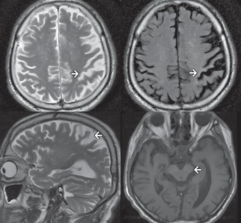 Aleksandra Szczepańska i wsp., Kliniczny i radiologiczny obraz CBD A B C D Rycina 1.