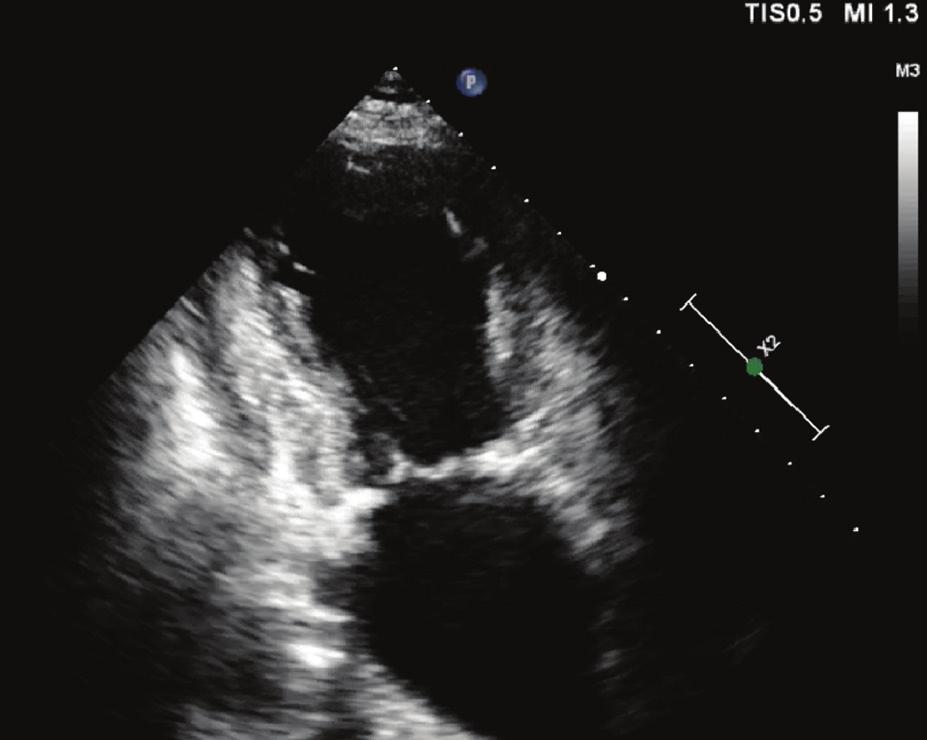 Folia Cardiologica 2015, tom 10, nr 1 Tabela 3.