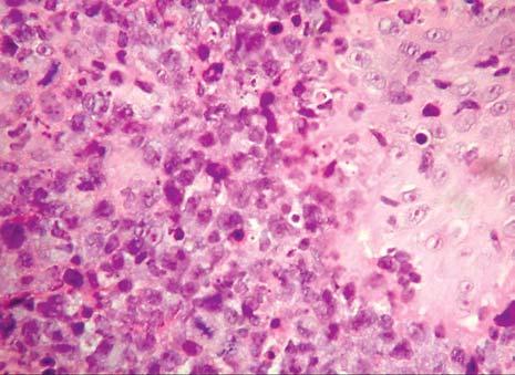 Hematologia 2010, tom 1, nr 1 Tabela 2. Schematy leczenia stosowane w chłoniakach nosowych/typu nosowego z komórek T/NK Table 2.