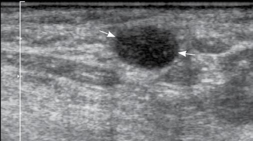 Pomyłki w diagnostyce ultrasonograficznej węzłów chłonnych położonych powierzchownie Ryc. 7.