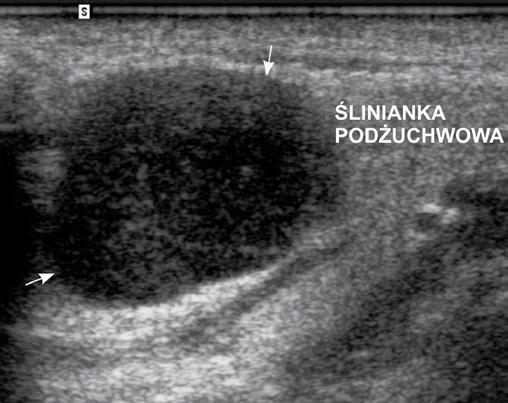 W jej wnętrzu są widoczne subtelne hiperechogeniczne struktury: linijne, punktowe lub rozlane (przykładowo oznaczono strzałkami).