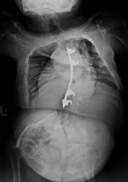 Szumera E. i wsp. Układowa kifoskolioza u rodzeństwa Ryc. 1A. Pacjent 1 radiogram AP kręgosłupa w 20 roku życia Fig.1A. Patient 1 AP radiograph of spine at 20 years of life Ryc.1B.