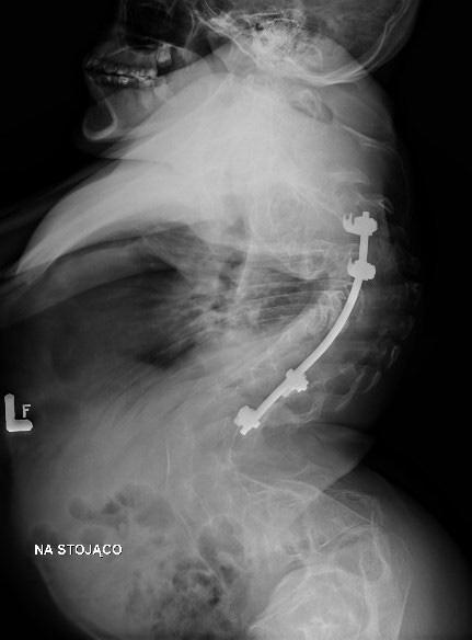 Patient 1 lateral radiograph of spine at 20 years of life stanie deformacji kręgosłupa, w 7 roku życia podjęto decyzję o operacji, ale, z powodu znacznej osteoporozy występującej u dziecka, nie było