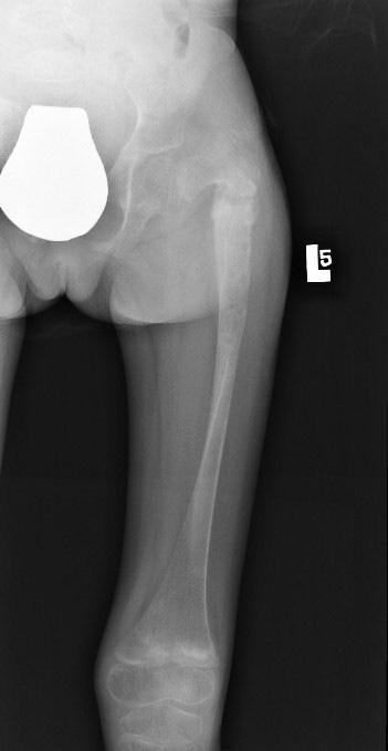 Szumera E. et al. Syndromic Kyphoscoliosis in Siblings kontrolne odbyło się w 12 roku życia chorej.