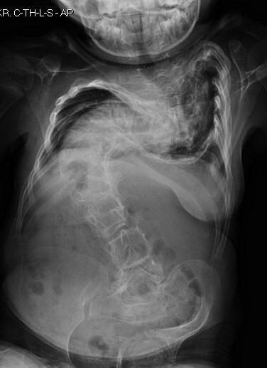 Hiperkifoza piersiowa o krótkim łuku, przekraczającym 90 także była stabilna. Decyzja Thoracic hyperkyphosis with a short arch of over 90 was also stable.