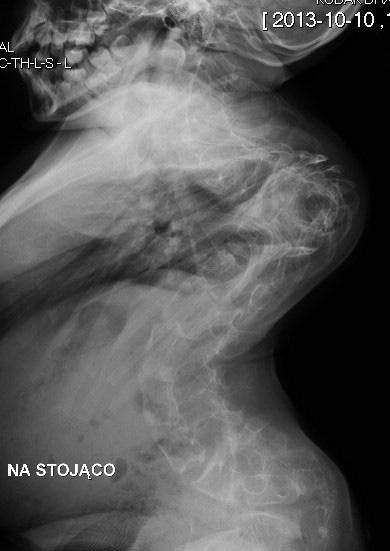 treatment. Ryc. 2. Pacjentka 2 radiogram AP: łukowata deformacja bliższego końca kości udowej ze zmniejszeniem kąta szyjkowotrzonowego Fig.2. Patient 2 AP radiograph: arch deformity of proximal femur with decreased femoral neck shaft angle Ryc.