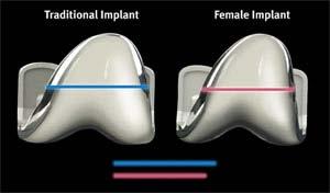 Potencjalne korzyści ze stosowania dedykowanych implantów (dla płci lub danej populacji).