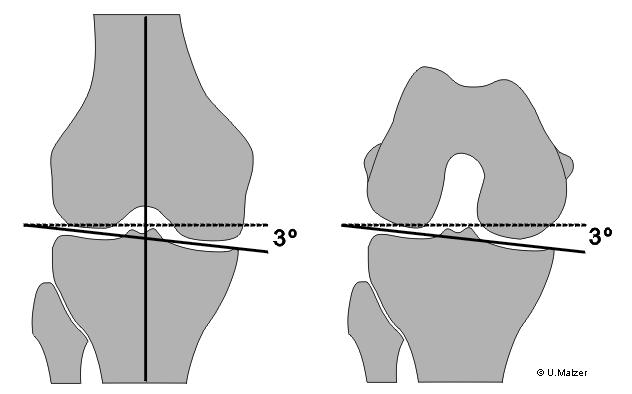 Kłykieć przyśrodkowy kości udowej jest większy oraz bardziej wystający i wypukły niż kłykieć boczny.