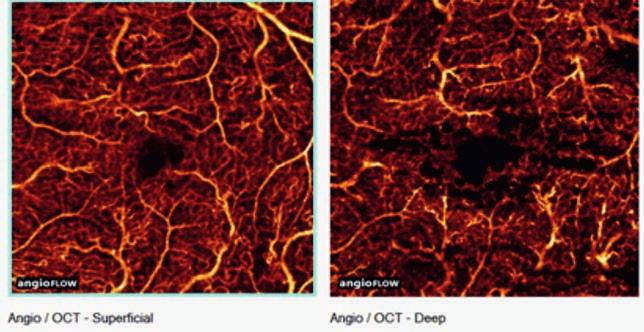 Zakrzep żyły środkowej siatkówki U chorych z zakrzepem żyły środkowej siatkówki angio- -OCT uwidacznia zaburzenia przepływu w splocie powierzchownym i głębokim [1, 2] (ryc.