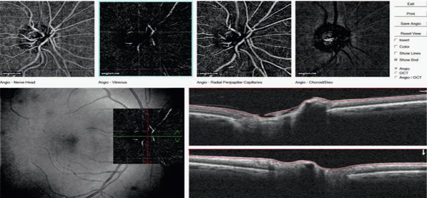 RYCINA 7 Angio-OCT prawidłowej tarczy nerwu wzrokowego.