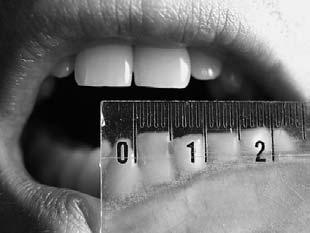Mean values of active movements of the TMJ in the group of adult without the pathology according to Cornu and Dechoux Rodzaj ruchu Wszyscy M (M) K (F) (Kind of move (All) N = 1644 N = 2053 ment) N =