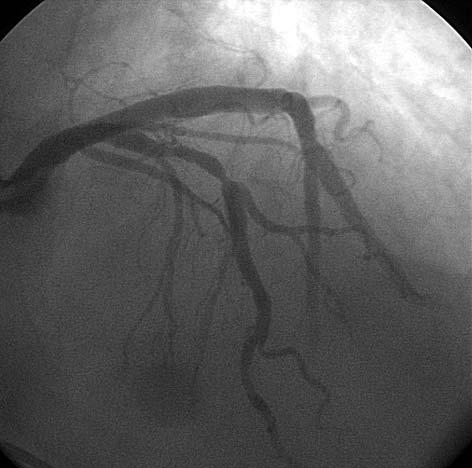 Angiogram prawej tętnicy wieńcowej, niekrytyczne zwężenie w proksymalnym odcinku tętnicy Dyskusja Obecność rytmu ze stymulatora w znacznym stopniu utrudnia rozpoznanie ostrej fazy lub przebytego