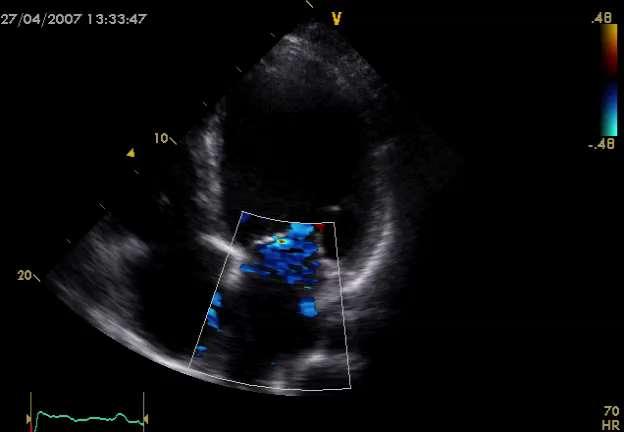 Echo niedomykalność mitralna- parametry rokownicze Wtórna niedomykalność mitralna Grigioni F., Enriquez-Sarano M., Zehr KL et al.