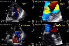. Long-term outcome of patients with heart failure and dynamic functional mitral regurgitation European Heart Journal