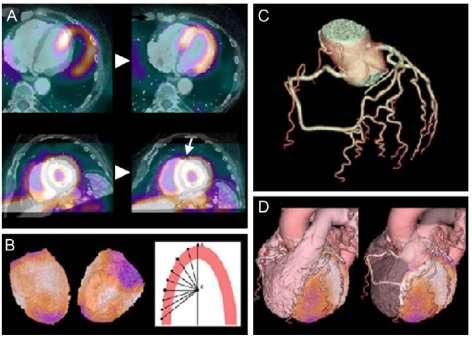 Tomografia komputerowa + PET A. Jednoczasowa akwizycja obrazów CT i PET B. Określenie konturów epikardium C. Określenie anatomii tętnic wieńcowych D.