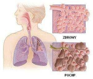 Choroby obturacyjne płuc Będące wskazaniami do przeszczepu to: przewlekła