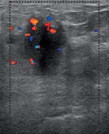 The differentiation of the character of solid lesions in the breast in the compression sonoelastography.