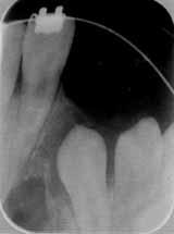 Rycina 3. Przykład kategorii A wgojenia przeszczepu tkanki kostnej. Figure 3. A category of successfully healed bone tissue graft. Rycina 4. Przykład kategorii B wgojenia przeszczepu tkanki kostnej.