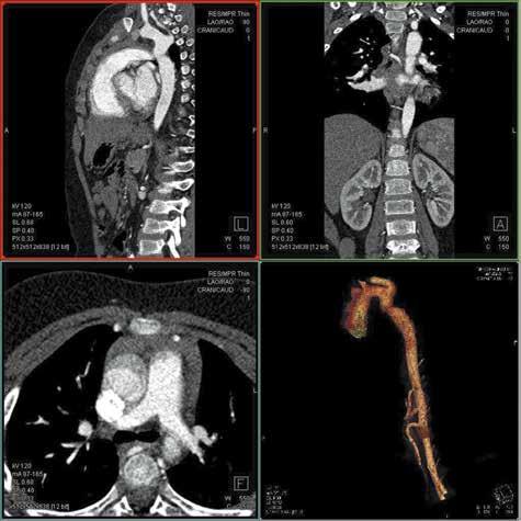 Lidia Strzelczuk-Judka et al., Value of CTA in children with CoA Results Echocardiography was performed in all 37 patients before referral for CTA.