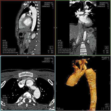 Folia Cardiologica 2014, tom 9, nr 3 A B C D Figure 3A D.