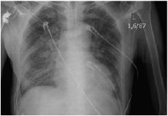 Zdjęcie 1. Obrzęk płuc Photo 1. Pulmonary edema w zapisie EKG wykluczono ostry zespół wieńcowy.